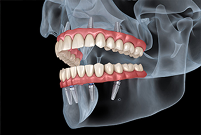 All on 4 Dental Implants
